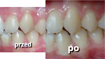 efekty prostowania zębów