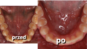 zęby dolne