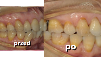 leczenie zębów metodą Invisalign