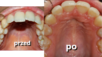zęby górne po leczeniu