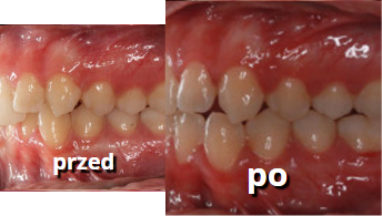 efekty leczenia zębów