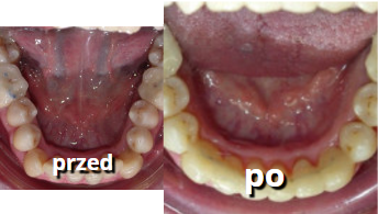 przed i po prostowaniu zębów